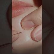 좁쌀여드름 짜기