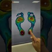 Foot Analysis With 2D Scanner