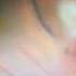 ازاله تليفات الشبكيه Epiretinal Membrane Peeling Americaneyeandretinacenter Drhasanbahrani عيون