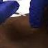 Cricothyrotomy