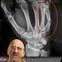 Boxer S Fracture Complications Shorts
