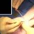 Endoscopic Carpal Tunnel Release
