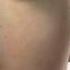 Rhinoplasty Nose Job Video Animation Assoc Prof Dr Guncel Ozturk MD DRGO