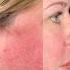 Treatment For Redness Rosacea