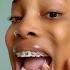 She Broke Her Braces And Did WHAT Orthodontist Reacts