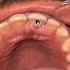 Upper Front Tooth Extraction Implant Procedure Surgery Accident Broken Incisors Jalandhar Straumann