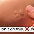 Mosquito Bite 5 Minutes Solution No More Itchiness Or Black Spots