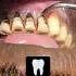 Pan Smokers Teeth Cleaning Teethcleaning Dirtyteeth