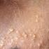 How To Get Rid Of Milia Treatment For Milia THAT WORKS