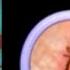 ASMR Remove Head Lice And Infection Removal Animation