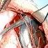 The 12th LION Global Broadcast Live Surgery Med El Cochlear Implantation Joachim Muller