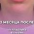 Увеличение губ без филлеров и навсегда Булхорн VY пластика Мой телеграм Dr Gretskova