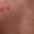 PanOxyl Acne Banishing Body Spray Post Workout Routine