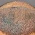 4450 Hair Grafts Sapphire FUE Hair Transplant By Dr Mohd Asif At CARA