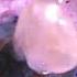 Open Sky Cataract Surgery And Corneal Transplant