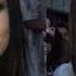 Jessica Albas S Nose And Lips FULL Cc Midface Shortening Procedure Subliminal