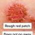 Watch OUT For These Types Of Skin Cancer Shorts
