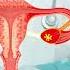 Stage 3 Ovarian Cancer Explained Symptoms Diagnosis And Treatment