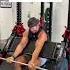 Bilateral Distal Biceps Tendon Rupture RARE Shorts