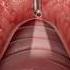 Bronchoscopy 3D Animation
