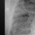 How Coronavirus Kills Acute Respiratory Distress Syndrome ARDS COVID 19 Treatment