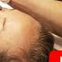 SkinPen Microneedling Don T Wait Til Forty Do It Now