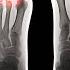 The Foot Specialist Your Toes Can Predict If You Ll Die Early This Will Fix Plantar Fasciitis
