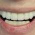 Красота на 6 имплантах Beauty On 6 Implants Implantation