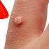 Say Goodbye To WARTS In Just 24 Hours No More Expensive Treatments