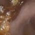 Deep Ear Wax Removal With Microsuction Super Satisfying EP1155