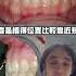 植牙醫師不敢說的真相 植牙失敗