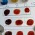 Blood Group Test