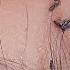 Pick Out Hundred Head Lice Take Out A Lot Of Big Lice