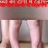 How To Treat Bow Legs In Babies Shorts Youtubeshorts Bowlegs