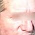 R Дегенерация мозга Тотальное слабоумие Болезнь Пика Dementia In Pick S Disease