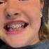 Braces Kidsfun Kidslearning