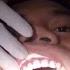 TEETH VENEERS
