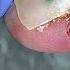 Ingrown Nail Broke Through The Side Roller Removal Of An Ingrown Nail By A Surgeon
