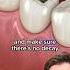 Tooth Filling A Fun Animated Overview