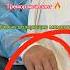 Болезнь Паркинсона операция на головном мозге пациент в сознании Parkinson S Disease