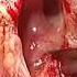 Movie 2 Tumor Resection Of A Squamous Cell Carcinoma