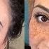 Sepkillarni Yo Qotish Usullari Сепкилларни йукотиш усуллари Веснушки