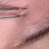 빠져드네 Blackheads Blackheadcaique 여드름 피부 피부관리