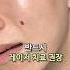 좁쌀 여드름처럼 보이는데 짜면 절대 안되는 4가지