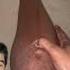 Edema