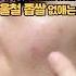 30 만 알고있는 좁쌀 여드름 없애는 꿀팁