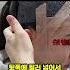 시술전후 엘프 귀 만들기