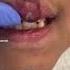 Scooter Lip And Teeth Injuries