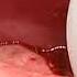 Movie 8 Removal Of The Skin Flap From The Defect
