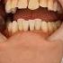 Restoring Length And Diastema With IVENEER And Sectional Matrix